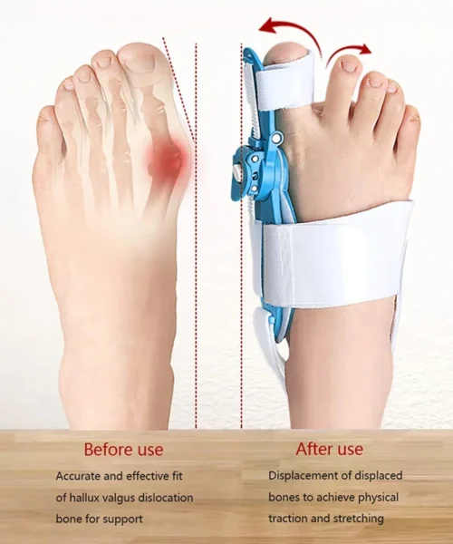 adjustable-bunion-corrector-for-men-and-women webp